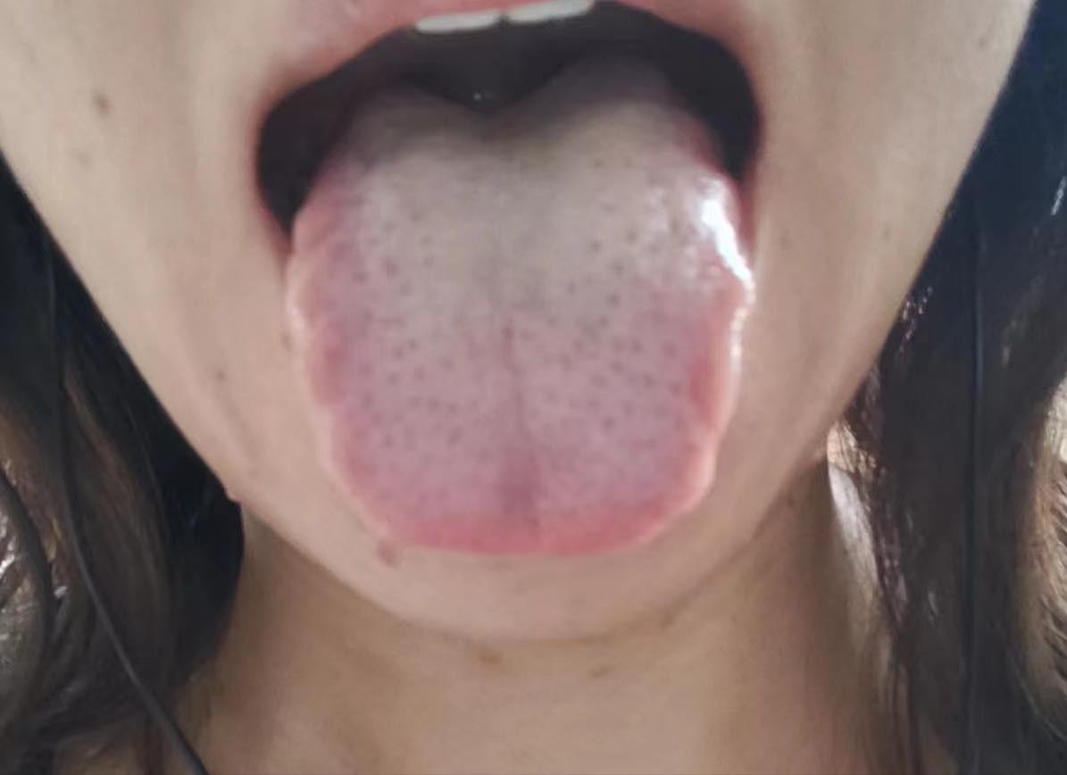 小姑娘年纪轻轻，才21岁，舌苔白腻的不像话，什么问题都占了
 
患者由于工作原因