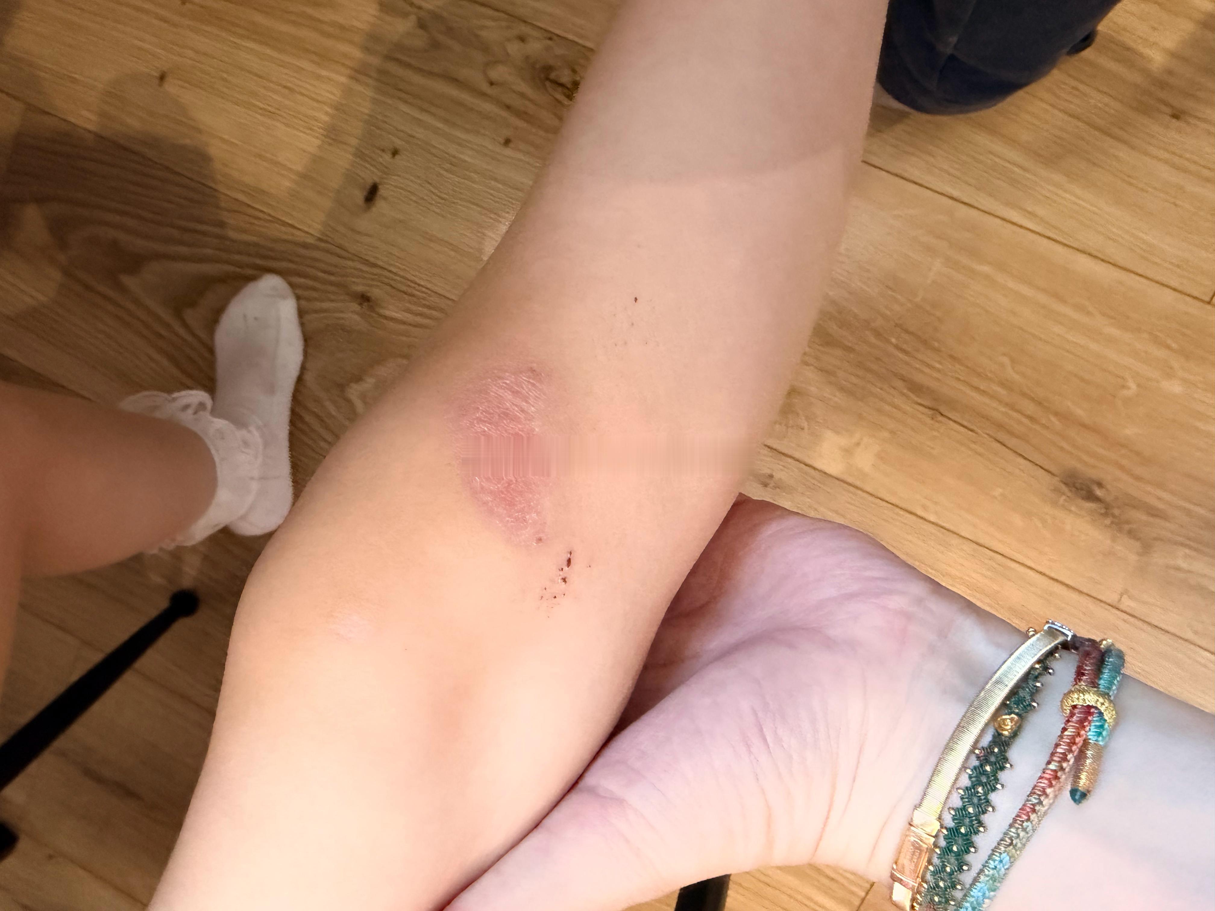 腿上那大块结痂的现在掉了 