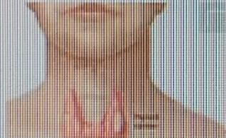 甲亢患者可得在饮食上多留个心眼，有些食物吃了可没好处。含碘高的食物首当其冲，像海