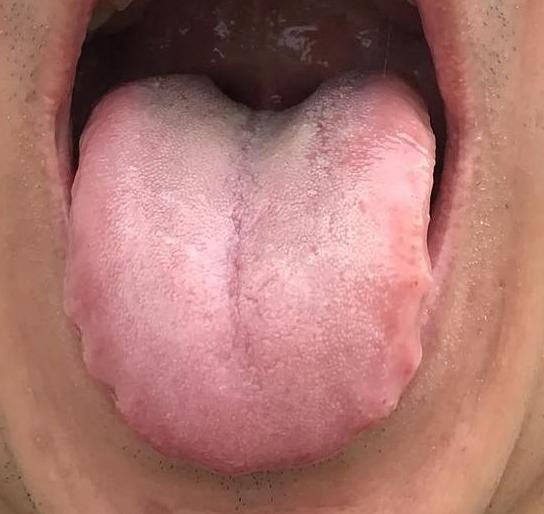 这种舌象，你就是把肝、脾、肾一起补也没有用，因为真正的元凶还存在！
 
这位患者