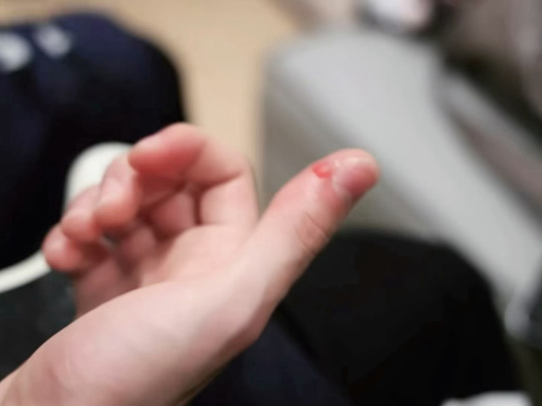 十指连心啊 啊啊我哭了 好心疼 受伤还在继续练习 宝宝真的好努力