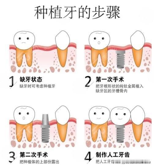 今天上午11点多在黄埔区某牙科诊所种了左上两颗牙，总体情况我在上一篇条文中说过了