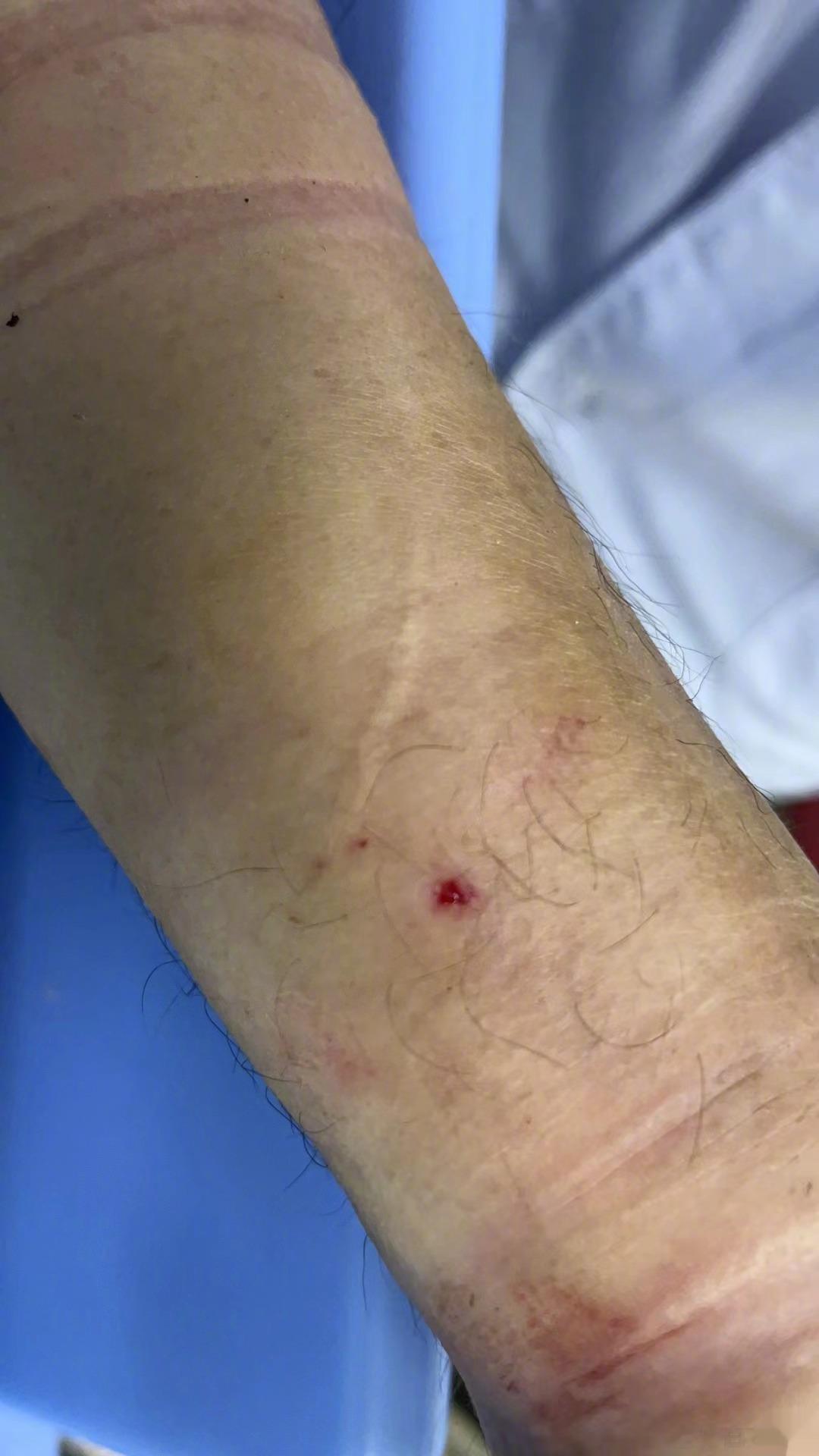 昨天中午11点，有医生在一个专家群里求助，发了病人的伤口照片，问大家，这是不是毒