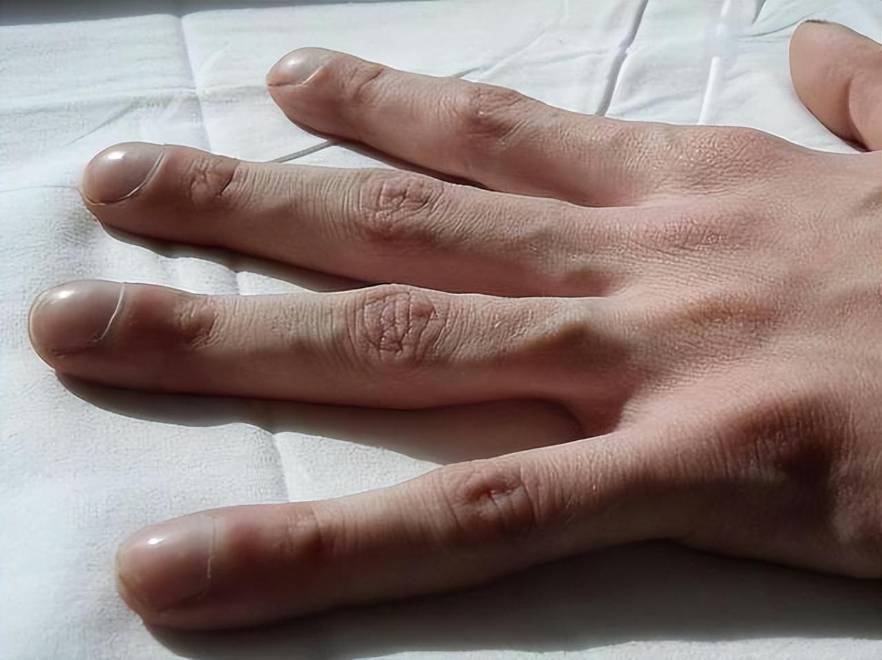 手指是脑梗的“显微镜”？告诫：手指有这3征兆，定要早点就诊！

脑梗发作之前往往