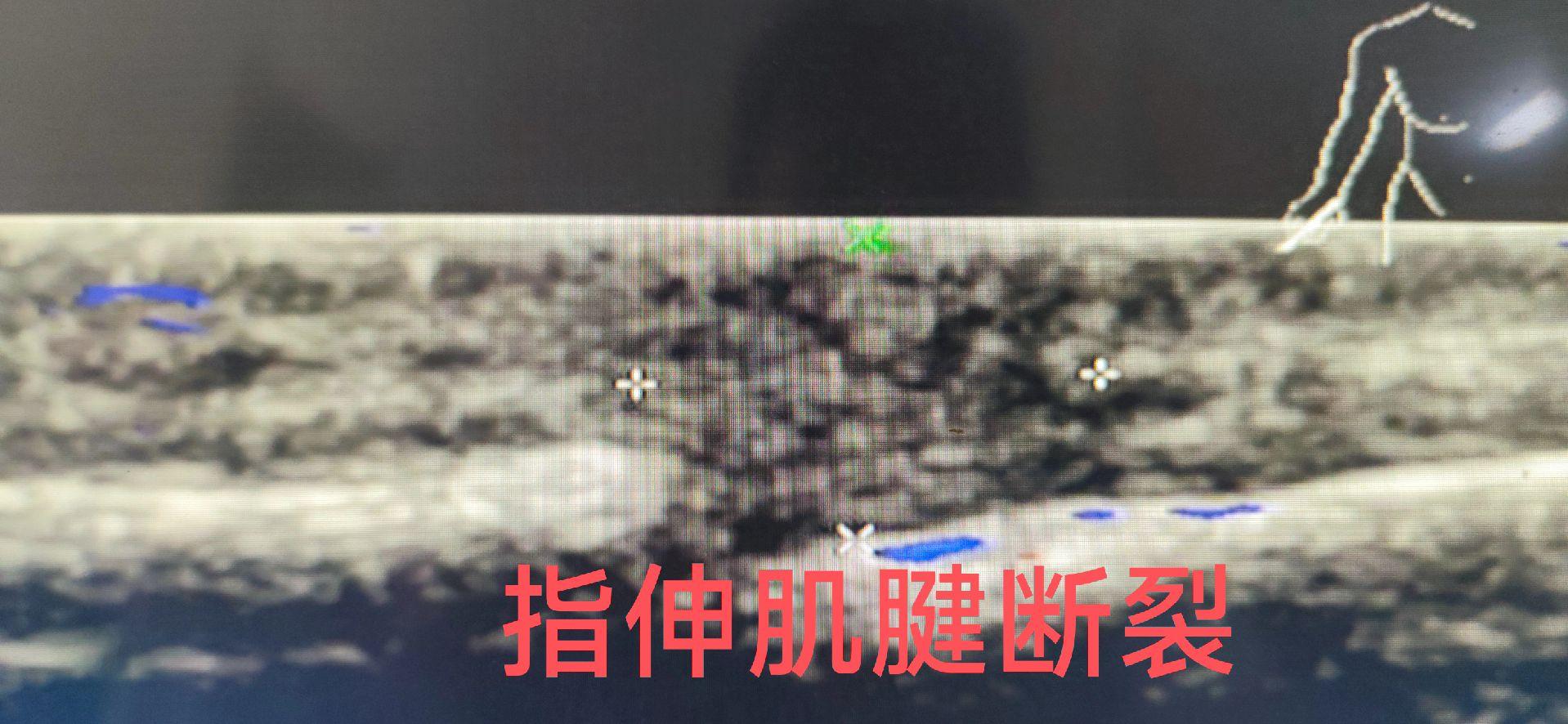 指伸肌腱断裂。环指被传动的皮带挤压伤、伸直受限。 指伸肌腱断裂，已手术