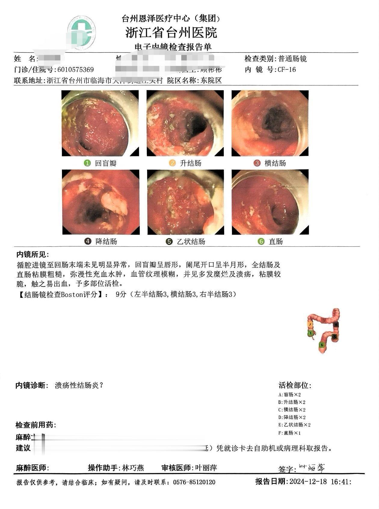 重症的溃疡性结肠炎，溃疡烂到动脉破裂！炎症性肠病，就是溃疡性结肠炎，克...