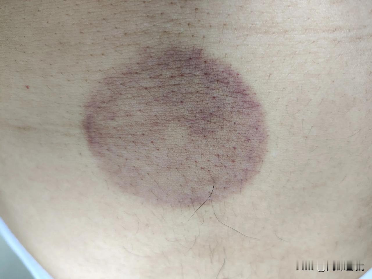 昨天又做了肚子拔罐，顺便在上边多加了一个罐，今天发现这个多加罐印明显，其他的肚脐