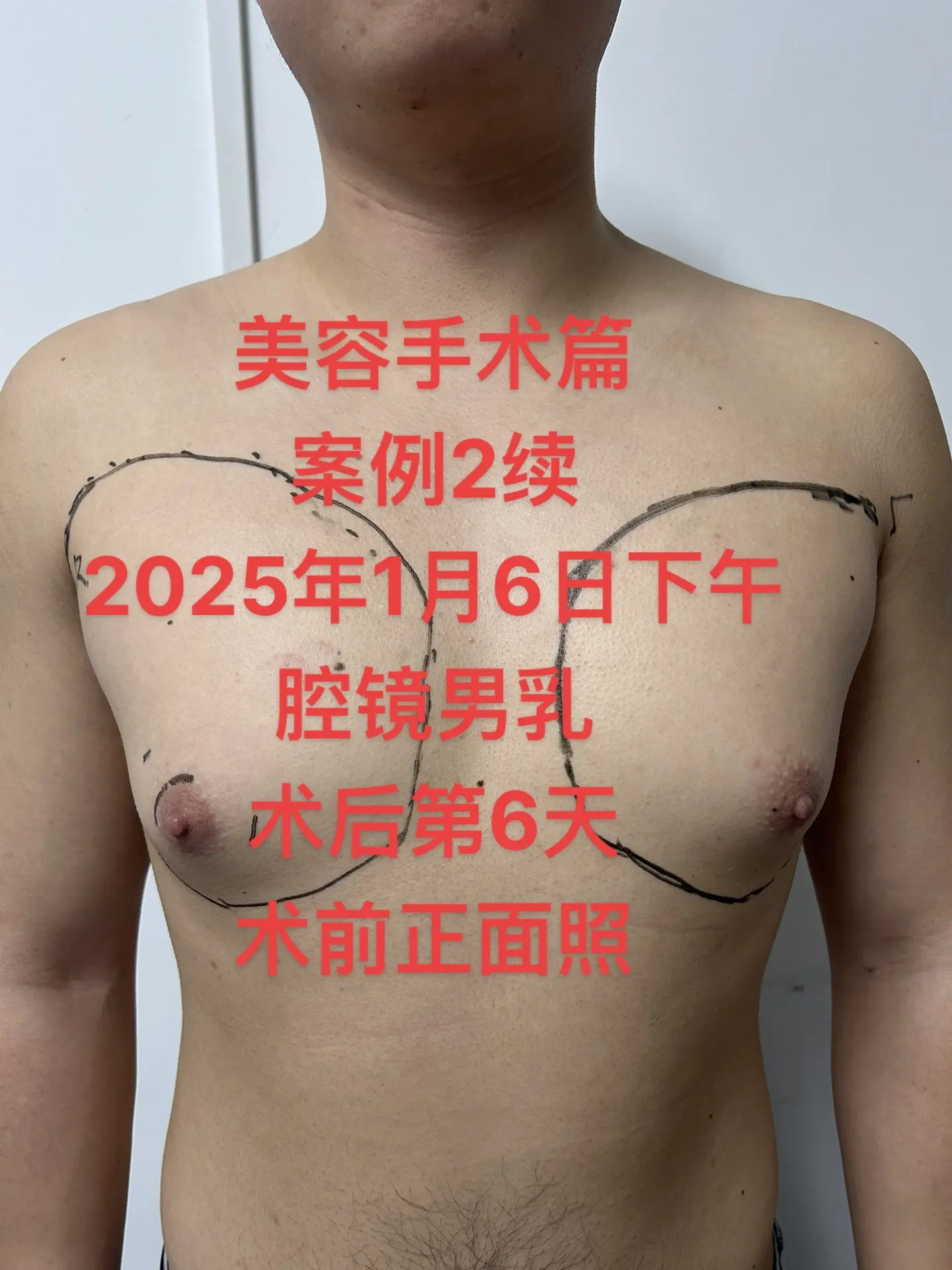 案例2随机男性乳房发育术前术后对比照片 肖像权已告知抖友并获得同意 内...