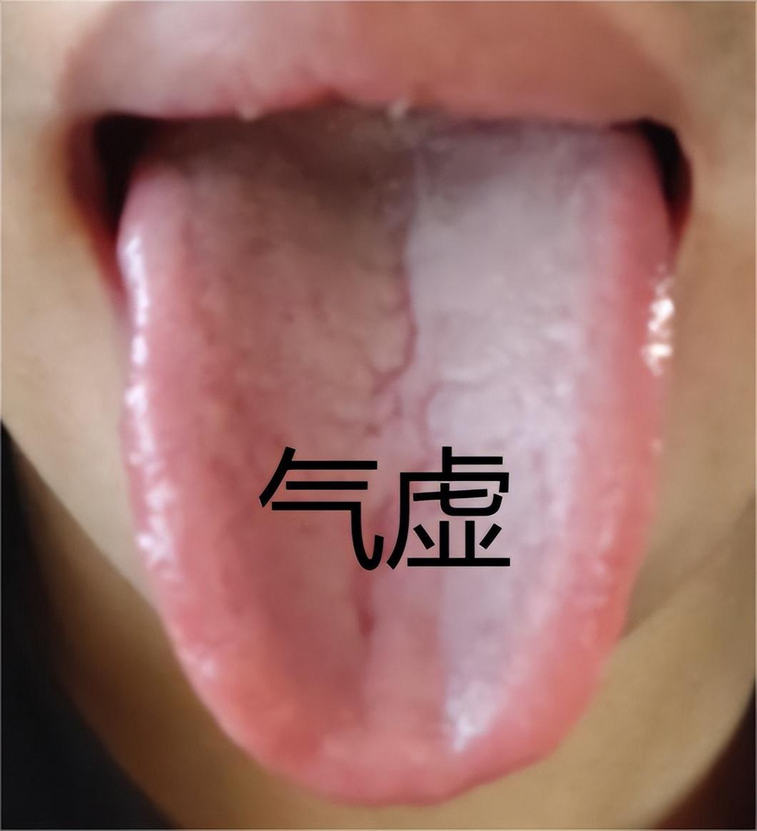 再虚也别瞎补，中医只用一分钟，教你分清气虚，血虚，阴虚，阳虚
 
平时坐诊遇见最