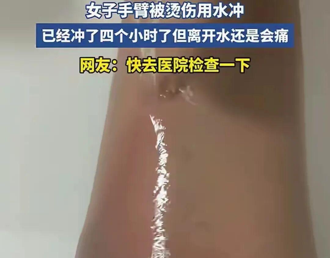 山东，一女子手臂不慎被烫伤，于是女子赶紧用流动水冲烫伤部位，结果没想到女子这么一