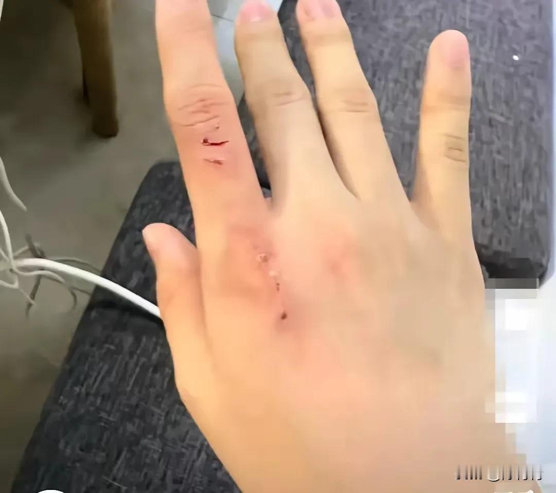 养狗人都会这样说，“我家狗不咬人。”假的！你看狗主人手被自己养的泰迪咬伤了。
