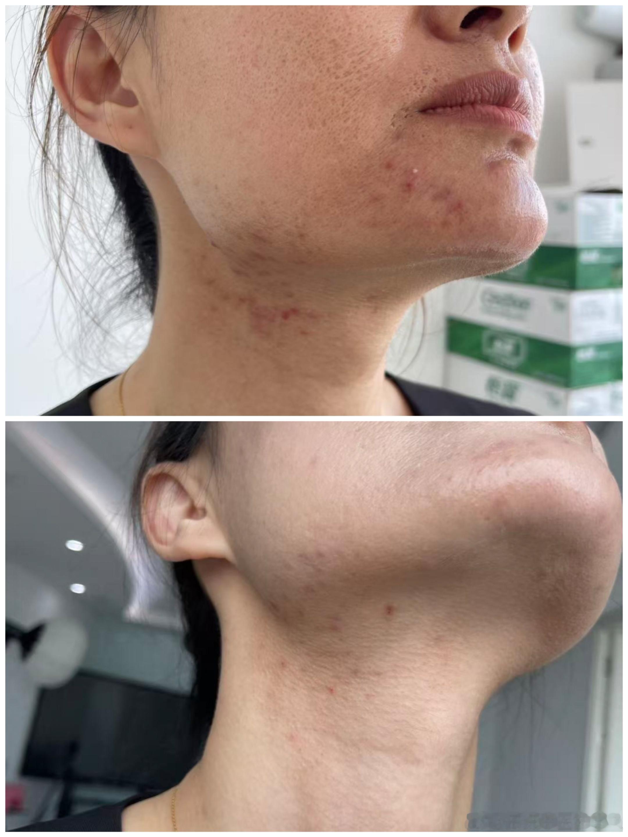 虽然患者的主诉是治疗痘痘但治好的不仅仅是痘痘20天的治疗，不仅仅痘痘好了同时还把