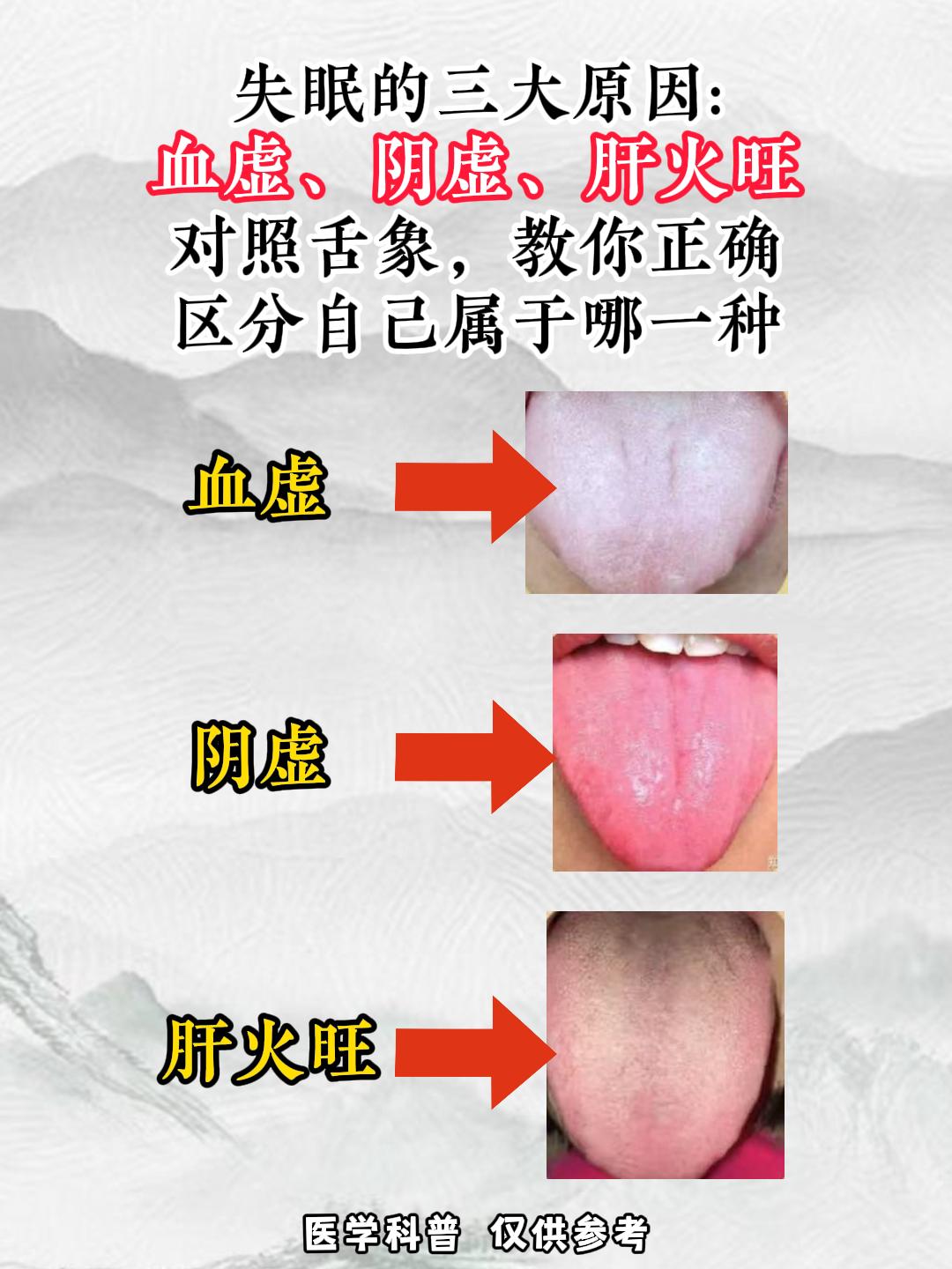 失眠的三大原因：血虚、阴虚、肝火旺对照舌象，教你正确区分，自己属于哪一种？#中医
