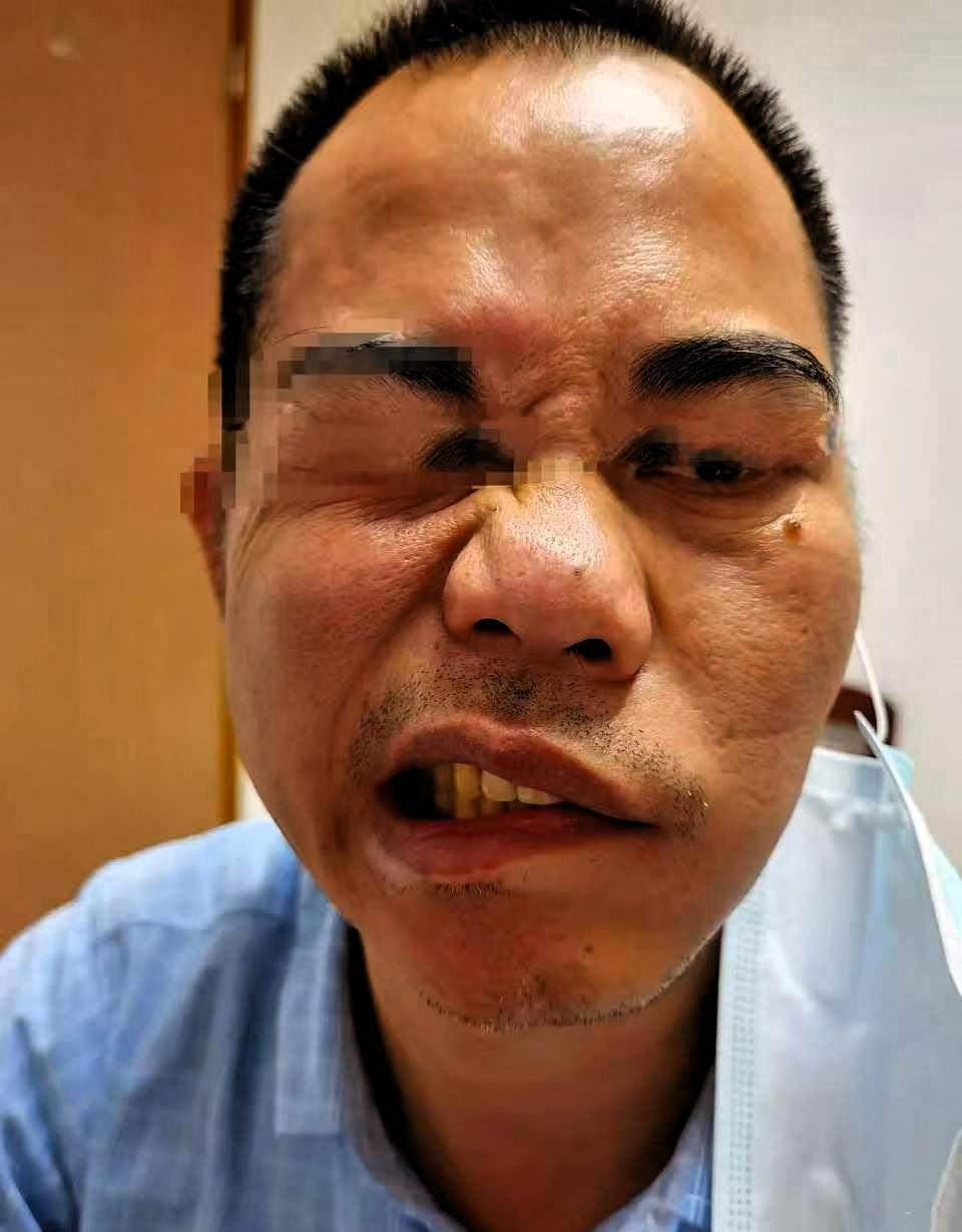 昨晚太热了，50多岁的大哥，不舍得开空调，对着风扇直吹了一整晚！

 这位大哥平