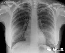 诊间趣事：小医生初见胸片大惊失色；老医生秒懂，想到如何帮她保守秘密！她，22岁，