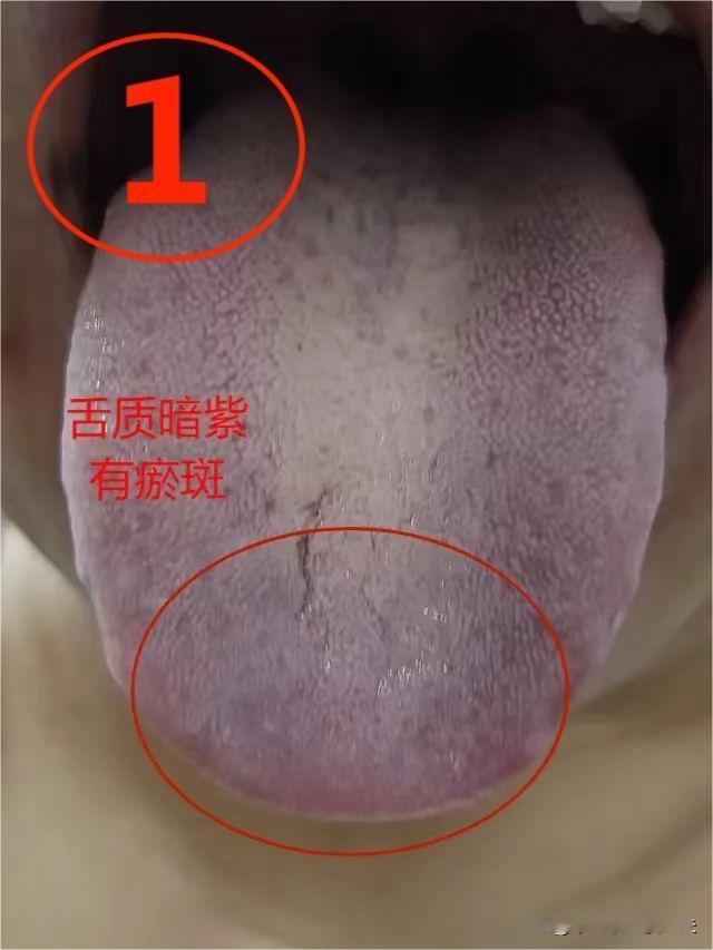 粉丝舌象分析图，我们来看一下一下三位粉丝的舌诊情况吧。#健康养生##舌诊分析##