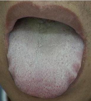寒生稀痰，热生黄痰，痰湿生粘痰，中医教你对症化痰。



第一个寒易生稀痰

表