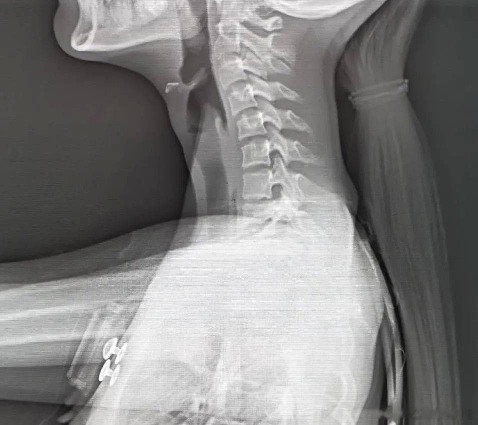 颈椎不舒服要注意，这十二种状况警惕颈椎病！ 你知道吗？颈椎因为位于缺少活动的胸椎