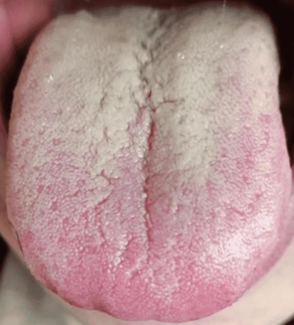 这种舌头，既有湿热又有脾肾两虚，其中还夹杂着肝郁，啥都占点儿，真是让人无从下手！