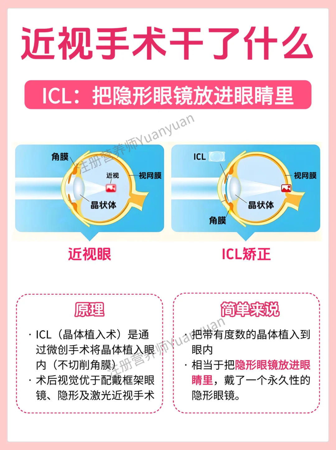 1篇看懂近视手术 你的眼睛也能“装设备”？