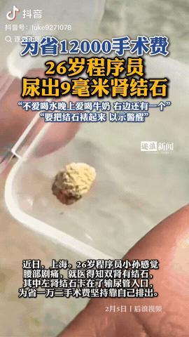 山东，一26岁程序员得了肾结石，他为了省12000手术费选择保守治疗，于是他每天