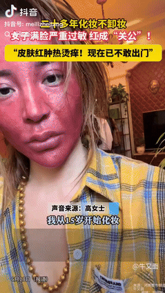 “脸都烂了，就别爱美了！”吉林一37岁的女子长达22年睡觉不卸妆，可以说没有一刻