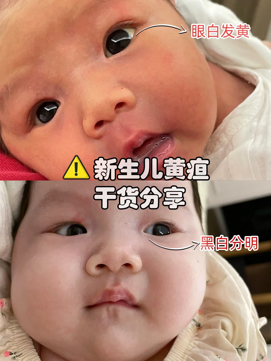新生儿黄疸不要急，等一个白白胖胖宝宝！