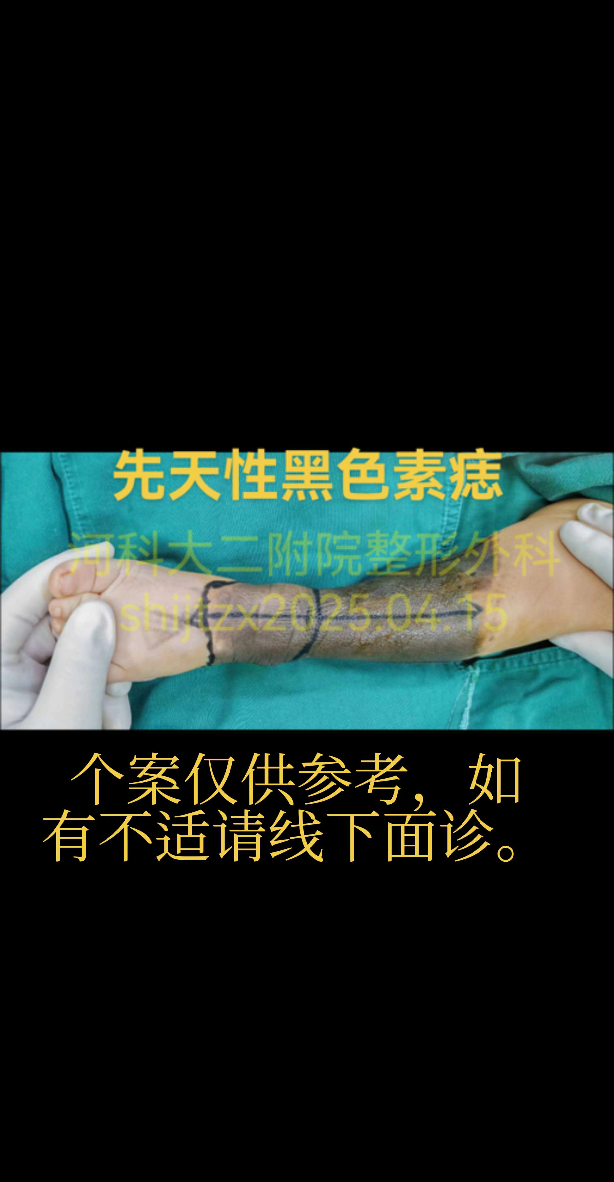 “黑胎记” 所谓的“黑胎记”就是色素性疾病，常见有：太田痣，咖啡杯斑...