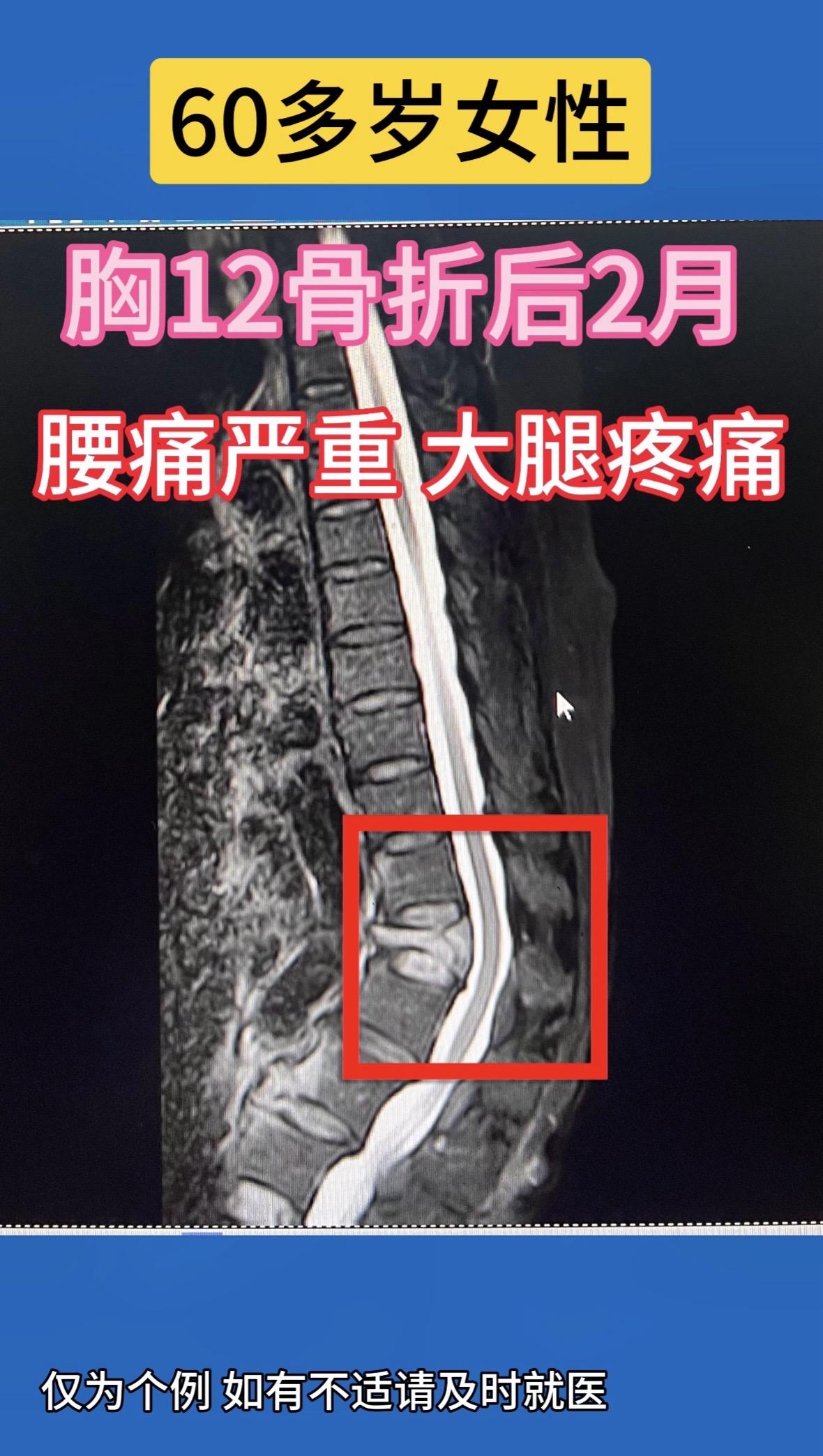 60多岁女性，胸12骨折后2月，腰痛严重，大腿疼痛。中老年胸腰段骨折如...