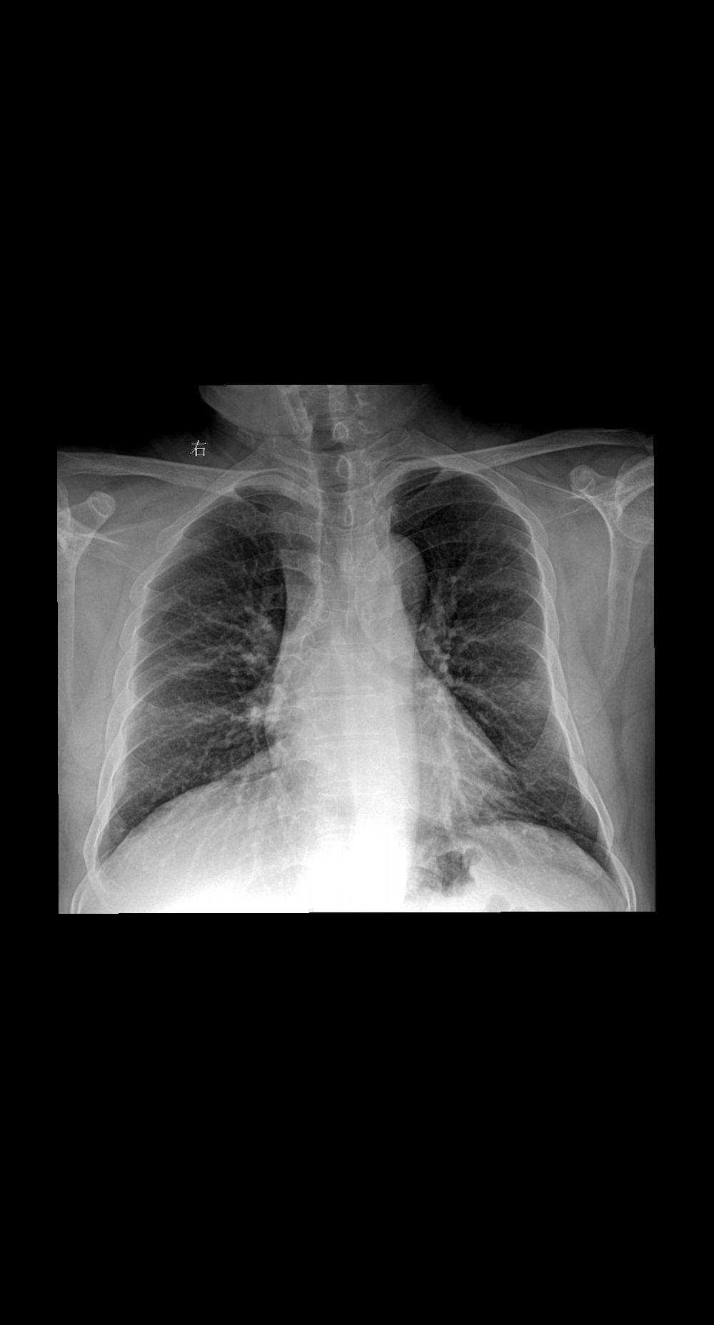 日常体检 无症状