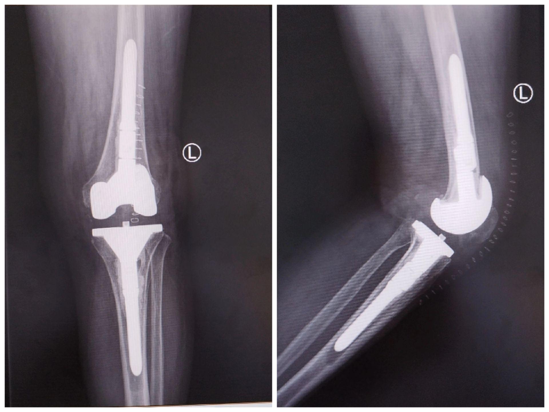 膝关节翻修术。双膝关节置换术后布氏杆菌感染（外院），清创旷置后二期翻修，重新走出自信的步伐。膝关节翻修