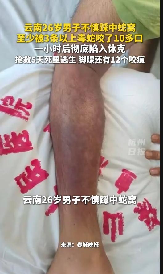 吓一跳！云南26岁小伙踩进蛇窝，被3条毒蛇咬12口，1小时休克！5天抢救捡回命…
