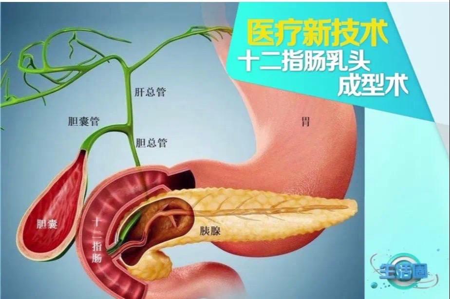 保护括约肌功能的ERCP.十二指肠乳头钛夹成型术！结石取出后再缝合，能...