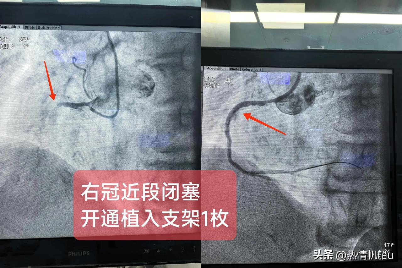 急性ST段抬高型心肌梗死
(右冠近段闭塞）
一.概念：
前降支主要为前壁及前间隔