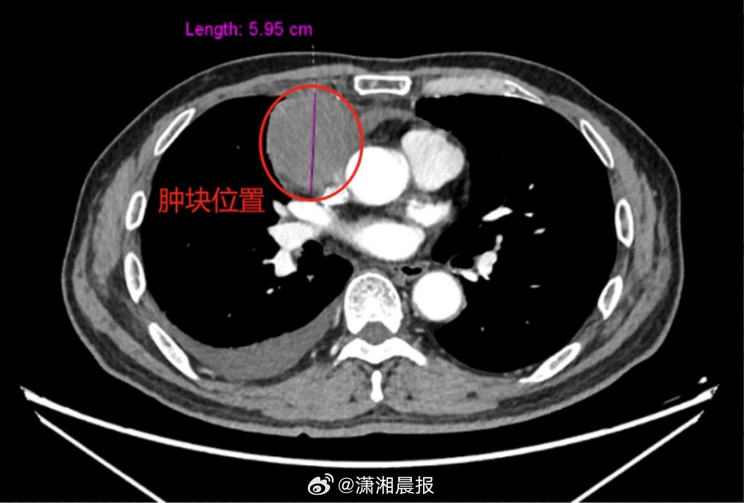 【#男子前胸胀痛查出6cm巨大纵隔肿瘤#；#专家谈纵隔肿瘤有哪些症状#】64岁的