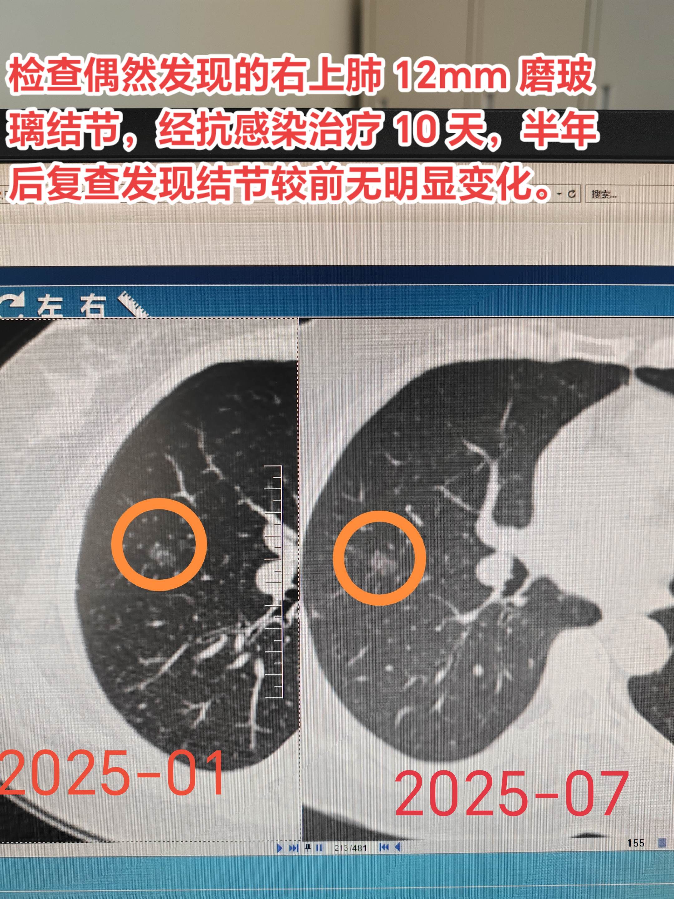 检查偶然发现的右上肺 12mm 磨玻璃结节，经抗感染治疗 10 天，半...