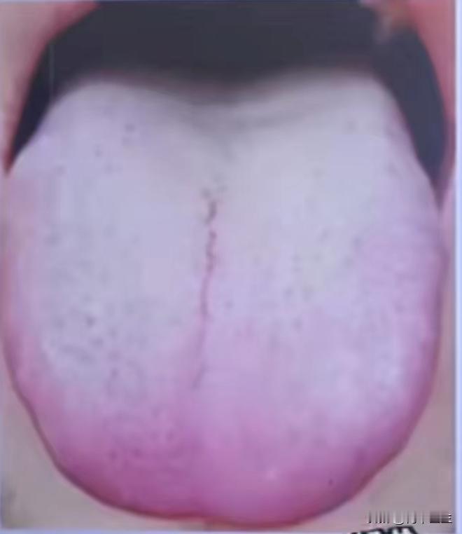 这种又白又有裂纹的舌苔，就算是肾再虚，也不能吃六味地黄丸

先来看舌象，我和大家