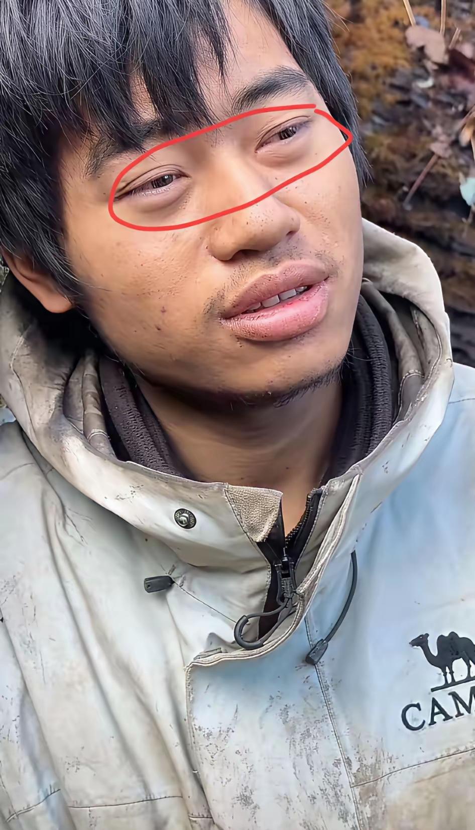 原来缺盐的后果这么严重！

这是钠降的太快不适应，就像污水里的鱼，捞出来跟清水里