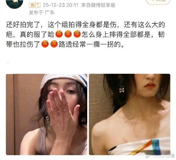 张子枫韧带也拉伤了张子枫因为拍戏身上留了好多疤，妹妹还多次公开强调疤痕是“角色在