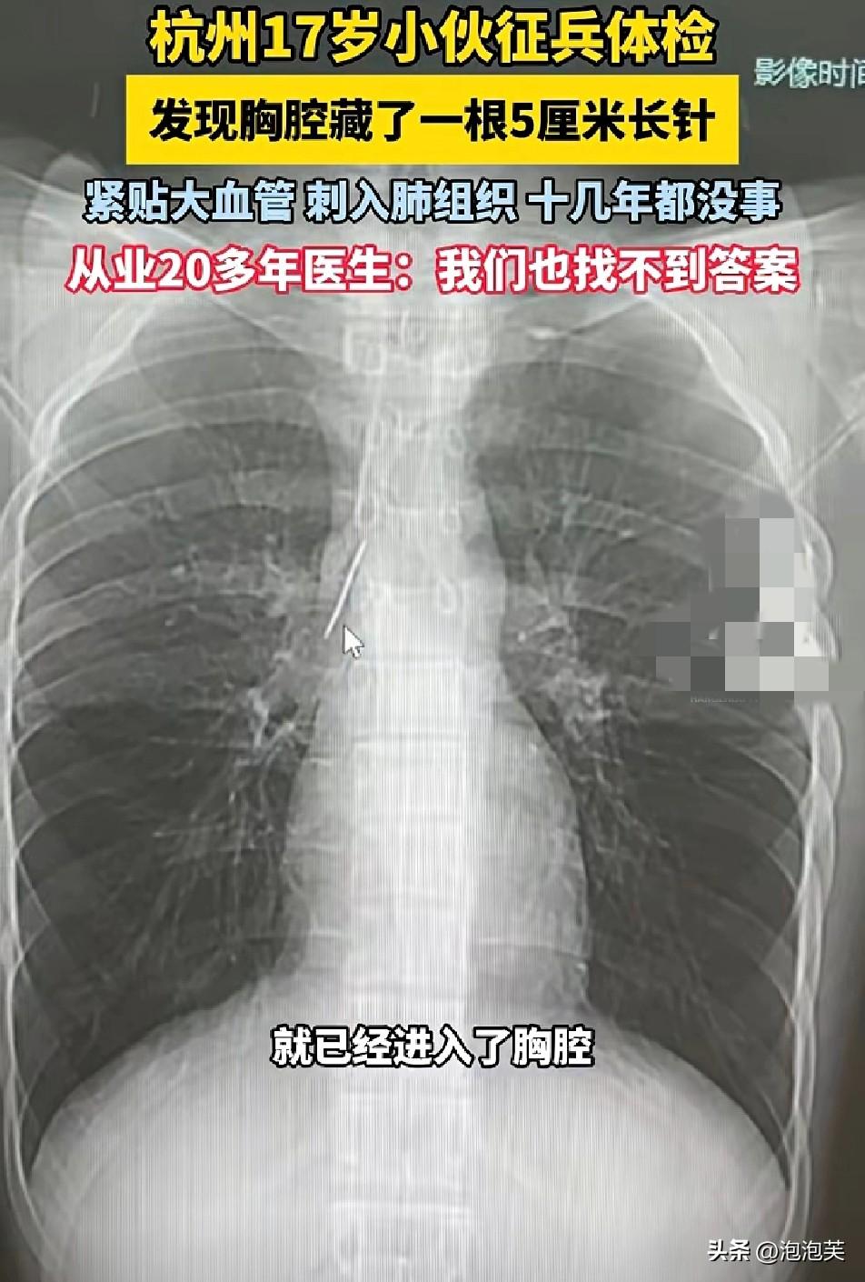 杭州一位17岁小伙

征兵体检时

医生竟在他胸腔里发现一根5厘米长的生锈针
