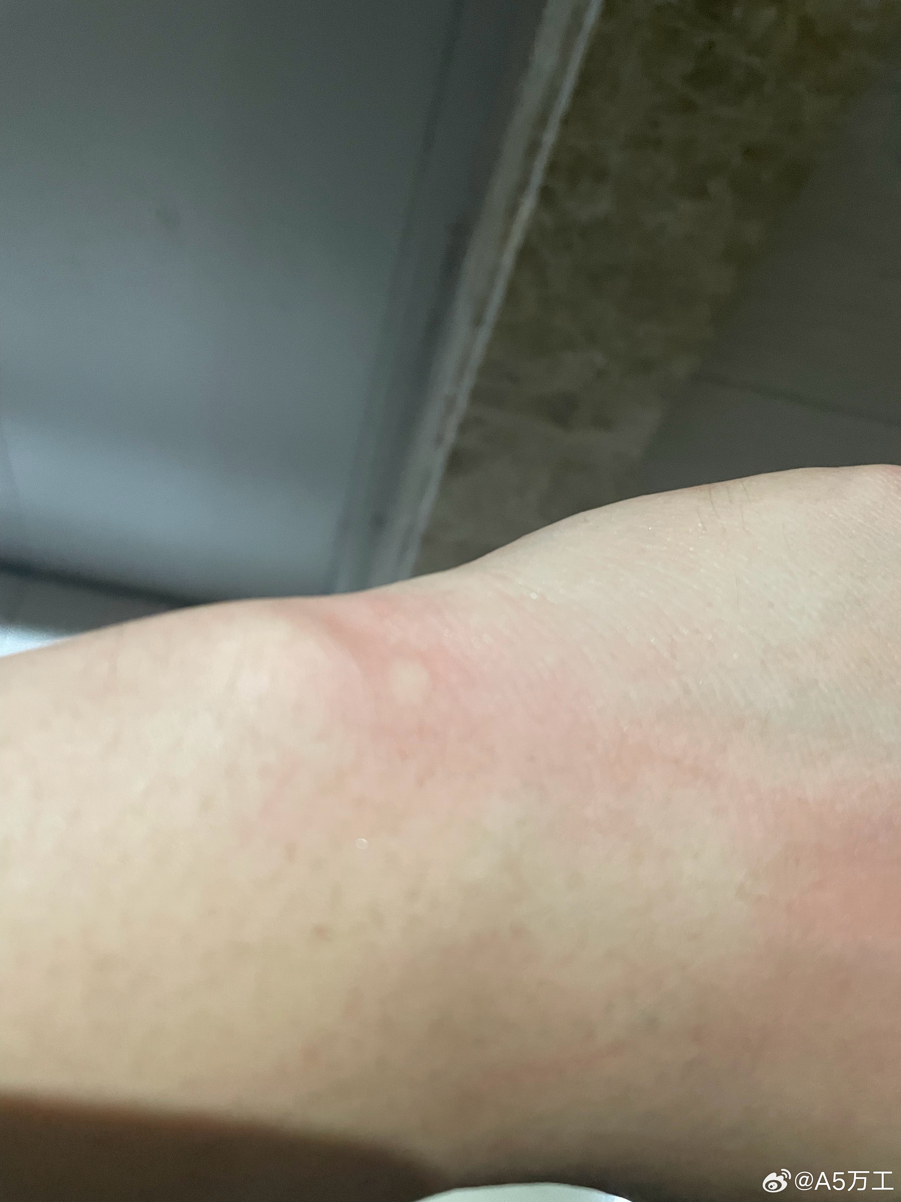 在楼下站了大约两分钟给电驴子充电，结果我现在两只手上大概有5个包在痒。。。包不大