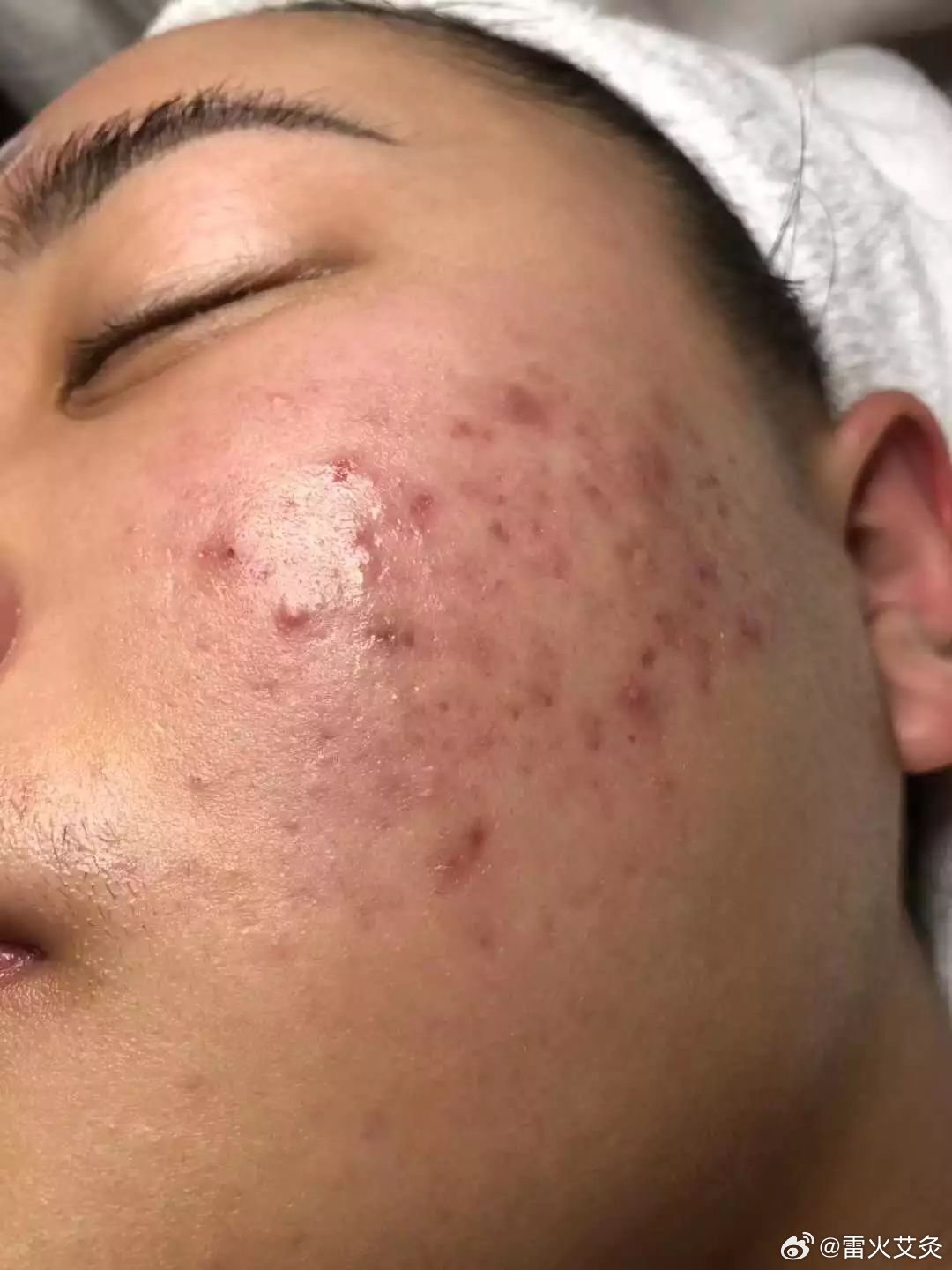 健康小知识：冬季痘痘疯长的原因 1、干燥的气候容易夺走人体水分，体内、体外都会大