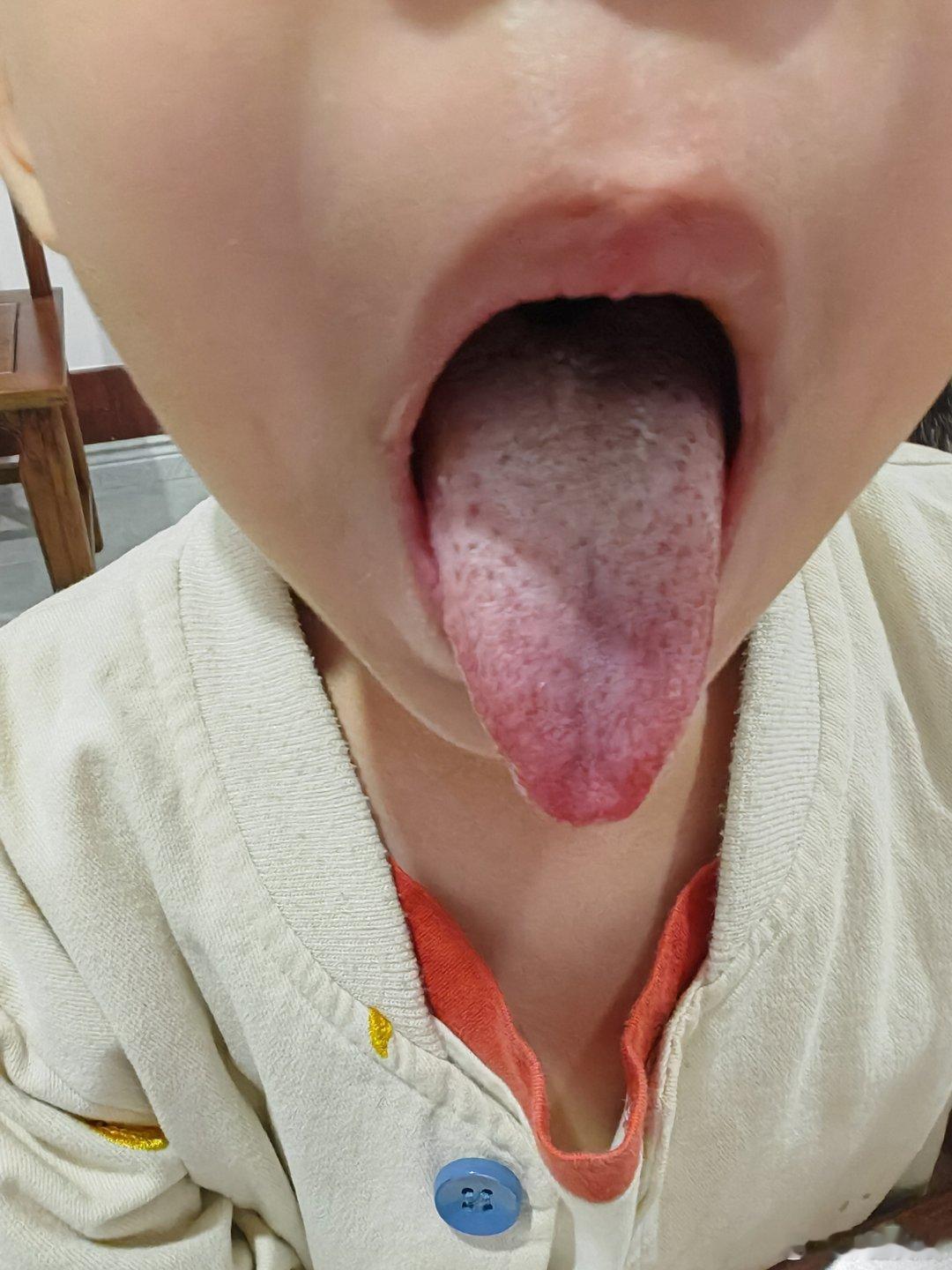 咳嗽三个月，期间水果饮料牛奶不断，把他舌象拍下来，这是有痰湿也有积滞郁热，你们看