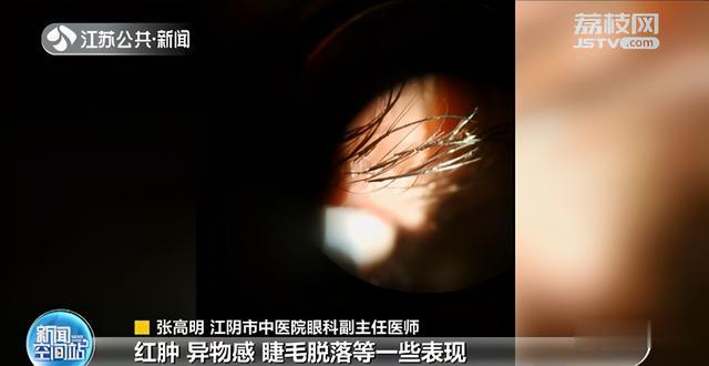 生活报 吓一跳！女子种完假睫毛，结果真睫毛差点保不住了