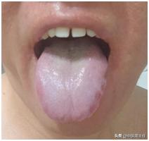 这种白腻苔，脾虚的再厉害，也别用归脾w、补脾健脾，方子不对，用再多也白费！
患者