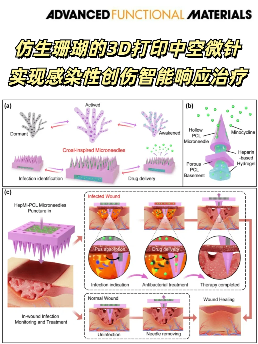 仿珊瑚中空微针实现感染创伤的智能响应治疗