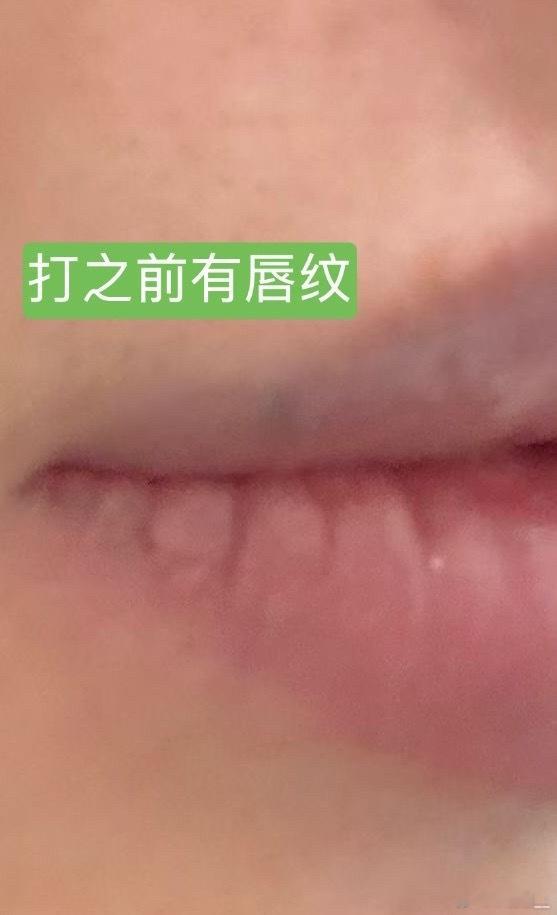 📝💉【深圳】改善红唇内卷＋增加唇容量见过太多打得很卡戴珊很外翻的我几年前打过