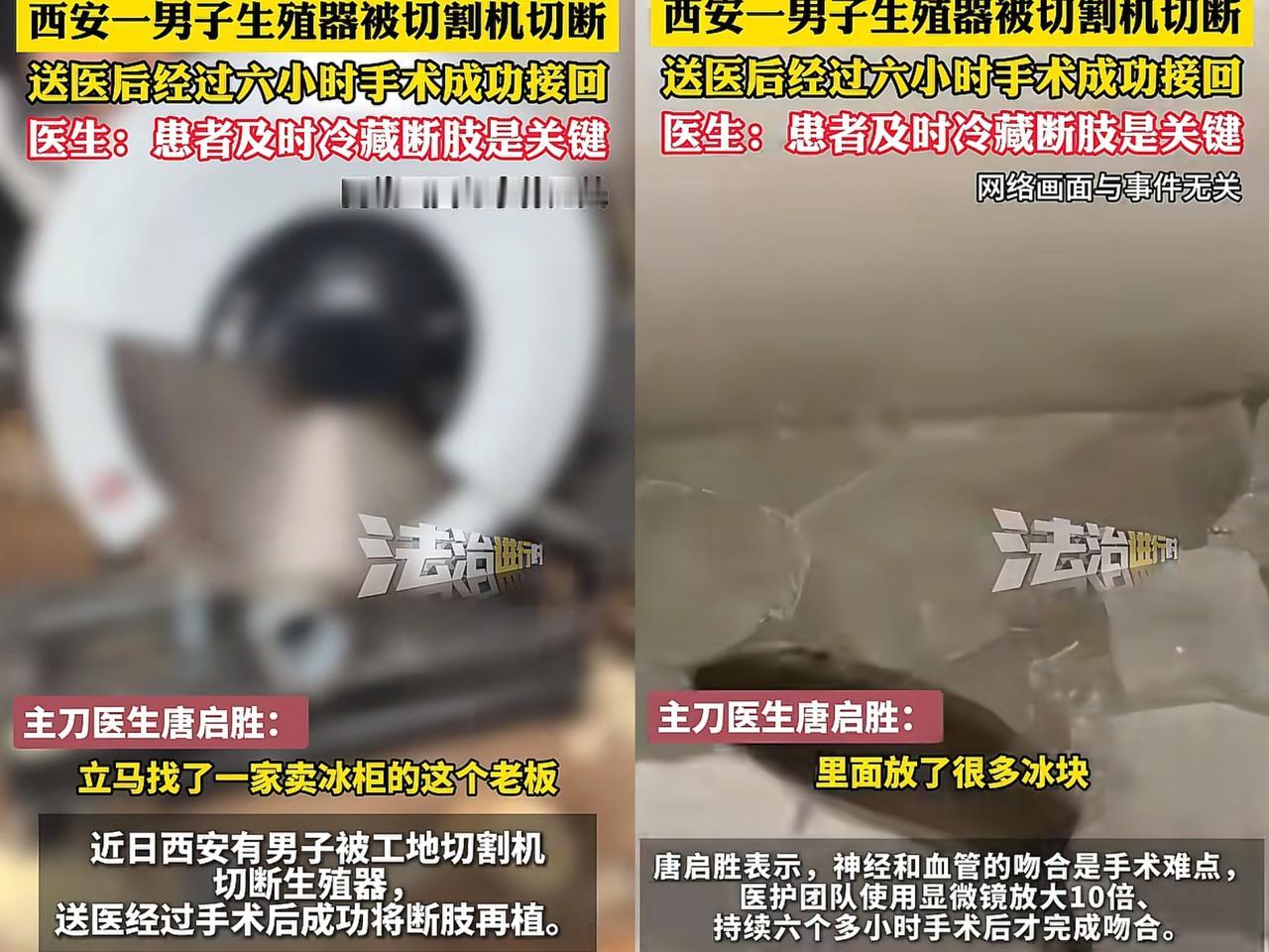 42岁钢筋工生殖器被切断，

妻子冷静救回，术后3周排尿通畅

工地上一不留神，
