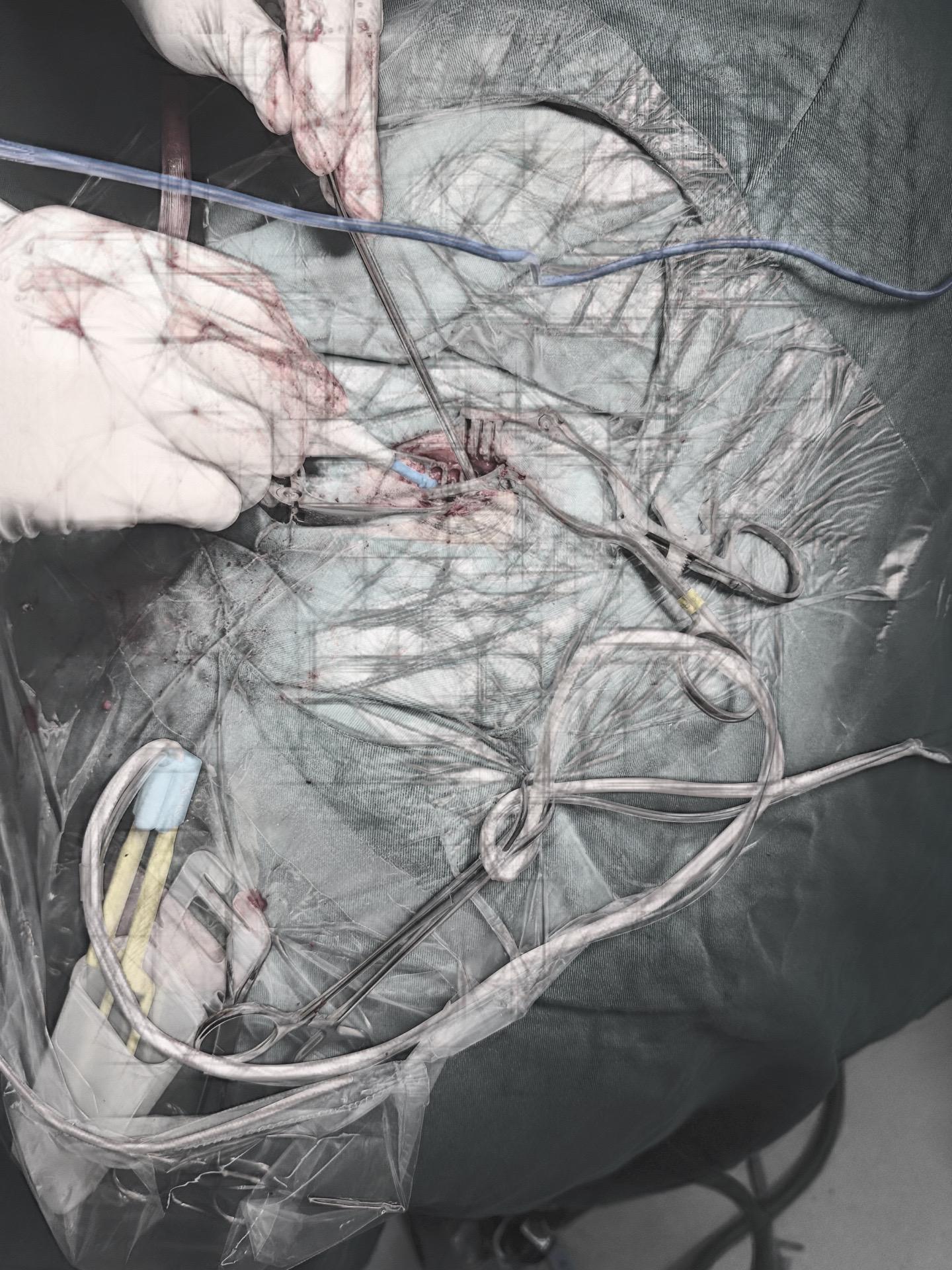 今日三台手术。1.椎动脉压迫导致的面肌痉挛，血管如蟒蛇般缠绕，减压术后...