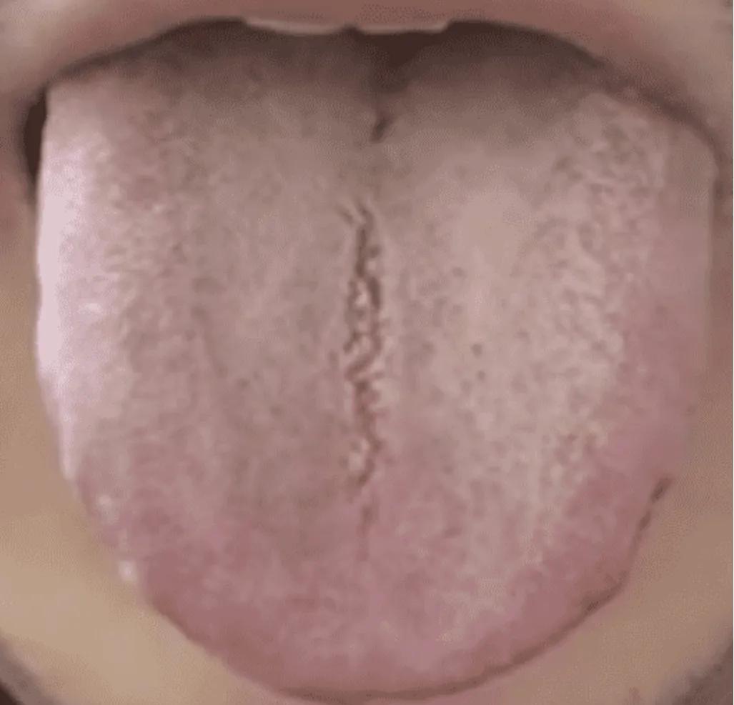 看到这种舌象，如果直接去健脾祛湿化痰，那么你真的是大错特错了

患者平时喉咙痰多